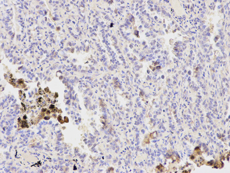 PPP1CB Antibody - Immunohistochemistry of paraffin-embedded human lung cancer using PPP1CB antibody at dilution of 1:200 (200x lens).