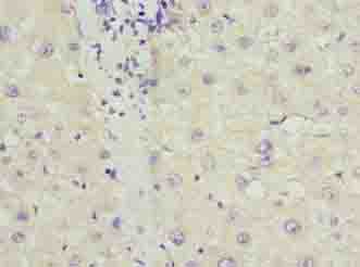 PPP1R3B Antibody - Immunohistochemistry of paraffin-embedded human liver cancer using antibody at dilution of 1:100.