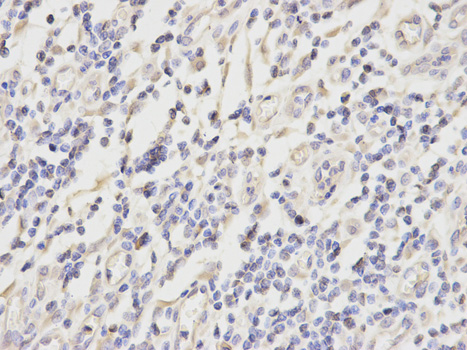 PRDX2 / Peroxiredoxin 2 Antibody - Immunohistochemistry of paraffin-embedded human stomach cancer using PRDX2 antibody at dilution of 1:200 (400x lens).