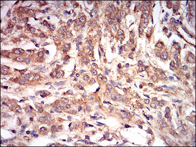 PRKAG1 / AMPK Gamma 1 Antibody - IHC of paraffin-embedded prostate cancer tissues using PRKAG1 mouse monoclonal antibody with DAB staining.