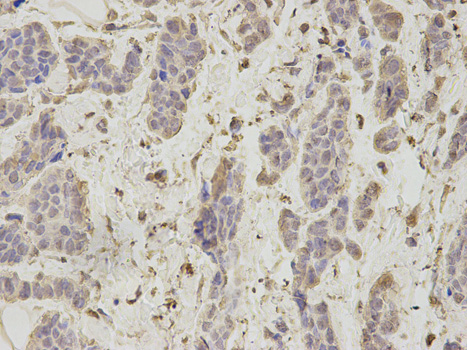 PSMA1 Antibody - Immunohistochemistry of paraffin-embedded human breast cancer using PSMA1 antibody at dilution of 1:100 (400x lens).
