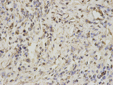 PSMA1 Antibody - Immunohistochemistry of paraffin-embedded human stomach cancer using PSMA1 antibody at dilution of 1:100 (400x lens).