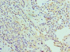 PSMD5 Antibody - Immunohistochemistry of paraffin-embedded human breast cancer using antibody at 1:100 dilution.