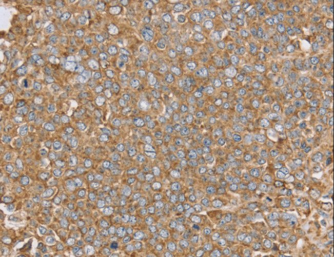 PTGER2 / EP2 Antibody - Immunohistochemistry of paraffin-embedded Human ovarian cancer using PTGER2 Polyclonal Antibody at dilution of 1:45.