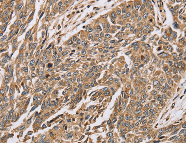 PTGER2 / EP2 Antibody - Immunohistochemistry of paraffin-embedded Human lung cancer using PTGER2 Polyclonal Antibody at dilution of 1:45.