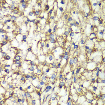 PTGES2 Antibody - Immunohistochemistry of paraffin-embedded human kidney cancer tissue.