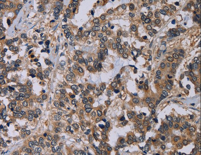 PVRL4 / Nectin 4 Antibody - Immunohistochemistry of paraffin-embedded Human liver cancer using PVRL4 Polyclonal Antibody at dilution of 1:60.