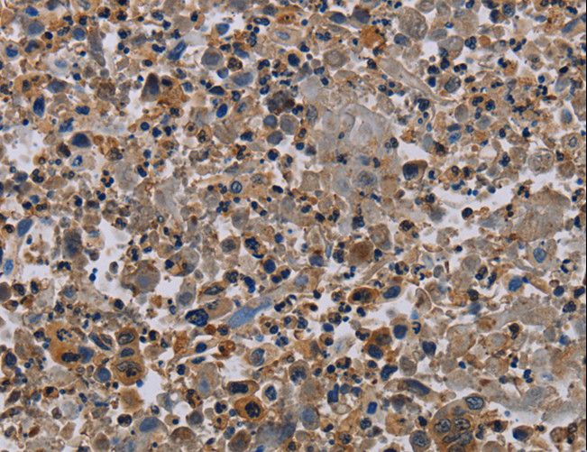 PVRL4 / Nectin 4 Antibody - Immunohistochemistry of paraffin-embedded Human lung cancer using PVRL4 Polyclonal Antibody at dilution of 1:60.