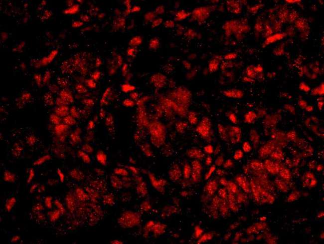 QIP1 / KPNA4 Antibody - Detection of Human KPNA4 by IHC-IF. Sample: FFPE section of human ovarian tumor. Antibody: Affinity purified rabbit anti-KPNA4 used at a dilution of 1:100. Detection: Red-fluorescent goat anti-rabbit IgG highly cross-adsorbed Antibody used at a dilution of 1:100.