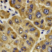 RAF1 / RAF Antibody - Immunohistochemical analysis of c-RAF staining in human liver cancer formalin fixed paraffin embedded tissue section. The section was pre-treated using heat mediated antigen retrieval with sodium citrate buffer (pH 6.0). The section was then incubated with the antibody at room temperature and detected using an HRP polymer system. DAB was used as the chromogen. The section was then counterstained with hematoxylin and mounted with DPX.