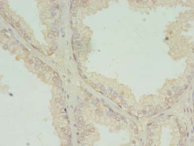 RCD1 / RQCD1 Antibody - Immunohistochemistry of paraffin-embedded human prostate cancer using antibody at dilution of 1:100.