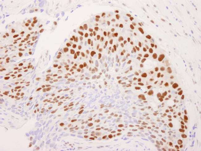 RCOR1 / COREST Antibody - Detection of Human CoREST by Immunohistochemistry. Sample: FFPE section of human breast tumor. Antibody: Affinity purified rabbit anti-CoREST used at a dilution of 1:250.