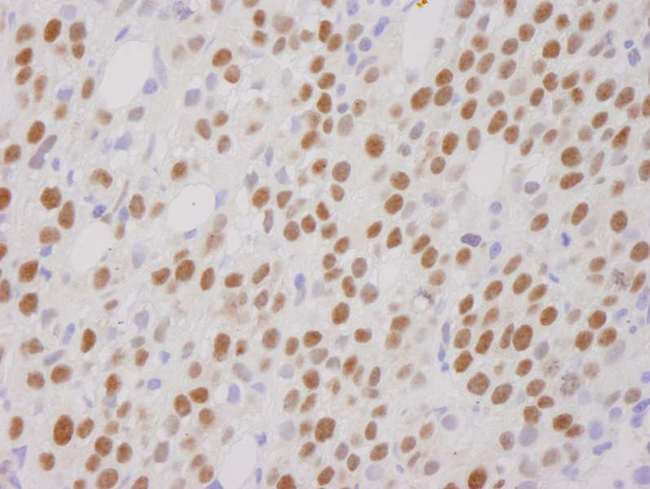 RCOR1 / COREST Antibody - Detection of Human CoREST by Immunohistochemistry. Sample: FFPE section of human metastatic bone marrow. Antibody: Affinity purified rabbit anti-CoREST used at a dilution of 1:250.