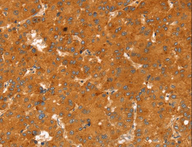 RGS4 Antibody - Immunohistochemistry of paraffin-embedded Human esophagus cancer using RGS4 Polyclonal Antibody at dilution of 1:25.