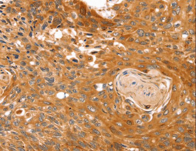 RGS4 Antibody - Immunohistochemistry of paraffin-embedded Human esophagus cancer using RGS4 Polyclonal Antibody at dilution of 1:25.