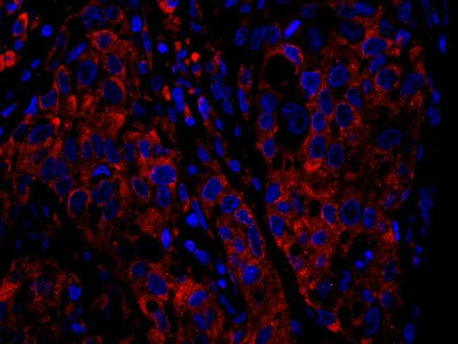 RPS6 / Ribosomal Protein S6 Antibody - Detection of Human RPS6 by Immunofluorescence. Sample: FFPE section of human breast carcinoma. Antibody: Affinity purified rabbit anti-RPS6 used at a dilution of 1:100. Detection: Red-fluorescent goat anti-rabbit IgG highly cross-adsorbed Antibody used at a dilution of 1:100.