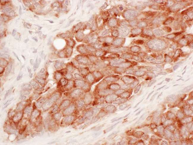 RTN3 / Reticulon 3 Antibody - Detection of Human Reticulon-3 by Immunohistochemistry. Sample: FFPE section of human ovarian carcinoma. Antibody: Affinity purified rabbit anti-Reticulon-3 used at a dilution of 1:200 (1 ug/ml). Detection: Vector Laboratories ImmPACT NovaRED Peroxidase Substrate.
