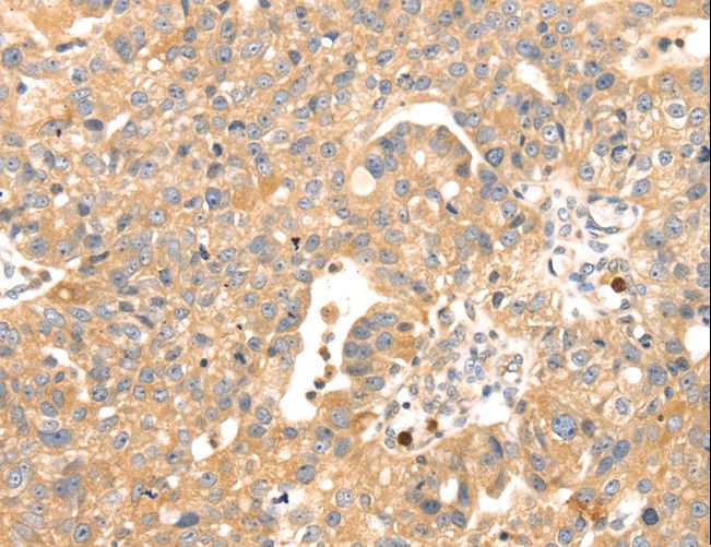 S100A12 Antibody - Immunohistochemistry of paraffin-embedded Human breast cancer using S100A12 Polyclonal Antibody at dilution of 1:45.