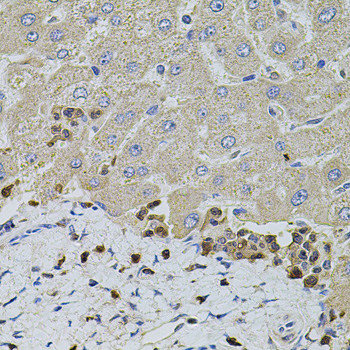 S100A12 Antibody - Immunohistochemistry of paraffin-embedded human liver injury tissue.