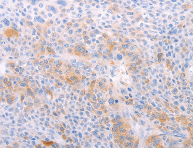 S1PR4 / SIP4 / EDG6 Antibody - Immunohistochemistry of paraffin-embedded Human liver cancer using S1PR4 Polyclonal Antibody at dilution of 1:40.