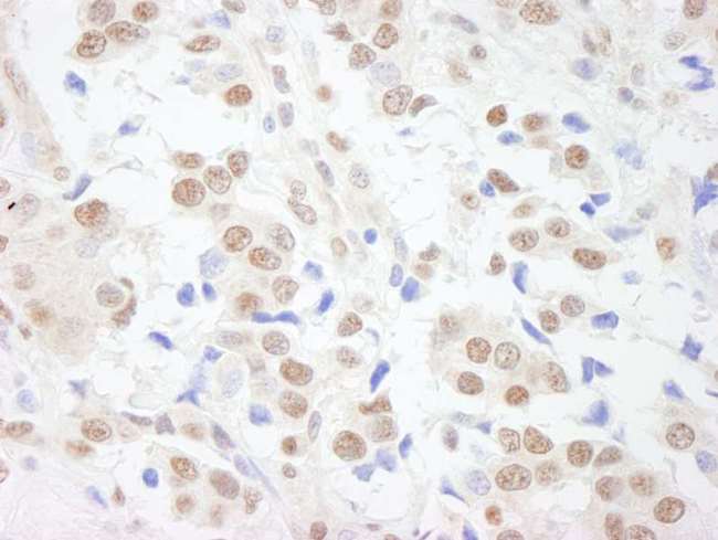 SAFB1 / SAFB Antibody - Detection of Human SAFB1 by Immunohistochemistry. Sample: FFPE section of human breast carcinoma. Antibody: Affinity purified rabbit anti-SAFB1 used at a dilution of 1:200 (1 ug/ml). Detection: DAB.
