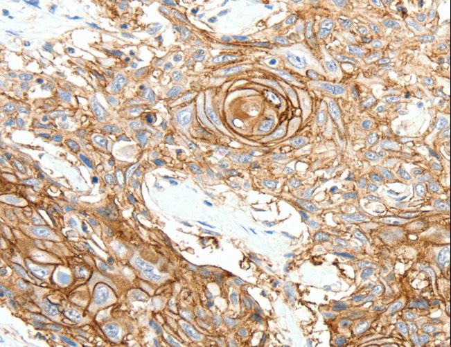 SCN10A / Nav1.8 Antibody - Immunohistochemistry of paraffin-embedded Human esophagus cancer using SCN10A Polyclonal Antibody at dilution of 1:25.