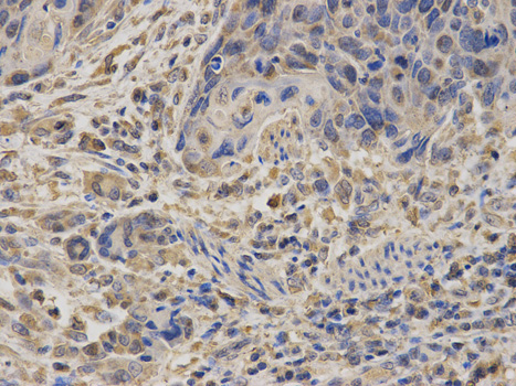 SDHA Antibody - Immunohistochemistry of paraffin-embedded human esophageal cancer using SDHA antibody at dilution of 1:100 (400x lens).
