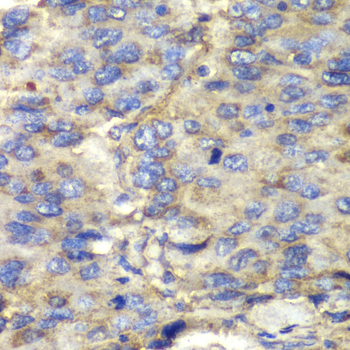 SDHA Antibody - Immunohistochemistry of paraffin-embedded human liver cancer tissue.