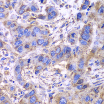 SDHA Antibody - Immunohistochemistry of paraffin-embedded human esophageal cancer tissue.
