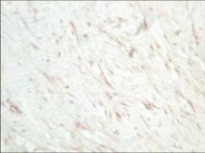 SFRP1 Antibody - Affinity Purified anti-Human SFRP1 antibody was used at a 1:800 dilution for 20 min to detect SFRP in human dermal hypertrophic scar tissue. Tissue was formalin-fixed followed by heat mediated antigen retrieval prior to blocking. HRP Gt-a-Rabbit IgG (p/n 611-1302) is suitable for secondary antibody detection.