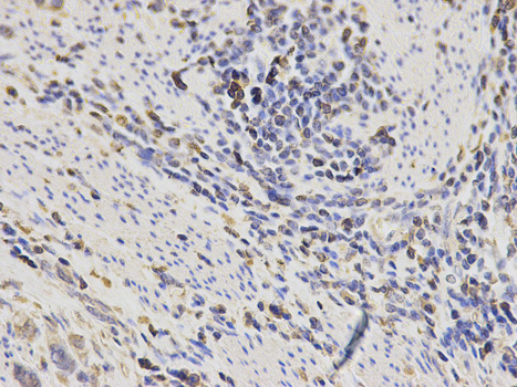 SH2D1A / SAP Antibody - Immunohistochemistry of paraffin-embedded human stomach cancer using SH2D1A antibody at dilution of 1:200 (400x lens).