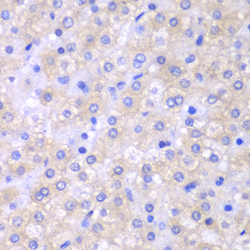 SH2D1A / SAP Antibody - Immunohistochemistry of paraffin-embedded human liver cancer tissue.