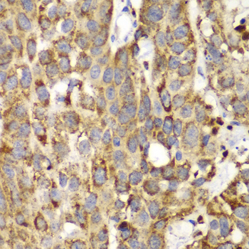 SHMT / SHMT2 Antibody - Immunohistochemistry of paraffin-embedded human lung cancer tissue.