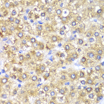 SHMT / SHMT2 Antibody - Immunohistochemistry of paraffin-embedded human liver cancer tissue.