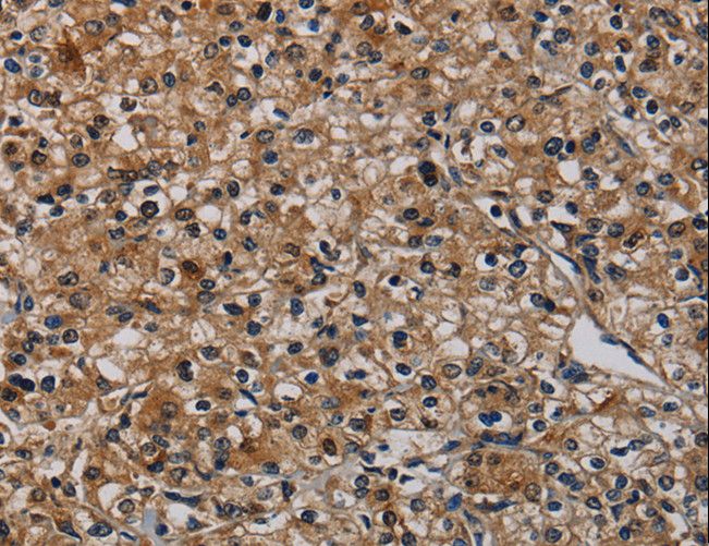 SIP / TP53INP1 Antibody - Immunohistochemistry of paraffin-embedded Human prostate cancer using TP53INP1 Polyclonal Antibody at dilution of 1:50.