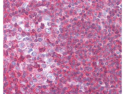 SIPA1 Antibody - Anti-Sipa1 Antibody - Immunohistochemistry. affinity purified anti-Sipa1 antibody was used at 1.25 ug/ml to detect signal in a variety of tissues including multi-human, multi-brain and multi-cancer slides. This image shows moderate to strong positive staining of lymphocytes within human tonsil at 40X. Tissue was formalin-fixed and paraffin embedded. The image shows localization of the antibody as the precipitated red signal, with a hematoxylin purple nuclear counterstain.