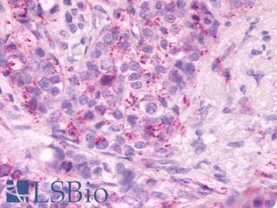 SIPR2 / S1P2 / EDG5 Antibody - Breast Carcinoma: Formalin-Fixed Paraffin-Embedded (FFPE)