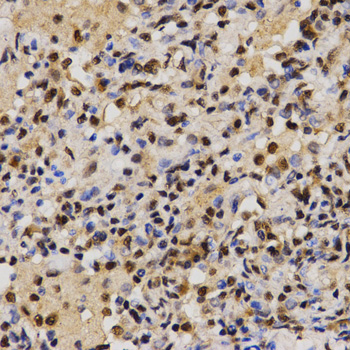 SKIV2L2 Antibody - Immunohistochemistry of paraffin-embedded human lung cancer tissue using MTR4 antibody at dilution of 1:200 (x400 lens).