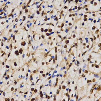 SKIV2L2 Antibody - Immunohistochemistry of paraffin-embedded human kidney cancer tissue using MTR4 antibody at dilution of 1:200 (x400 lens).