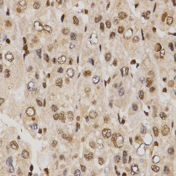 SKIV2L2 Antibody - Immunohistochemistry of paraffin-embedded human liver cancer tissue using MTR4 antibody at dilution of 1:200 (x400 lens).
