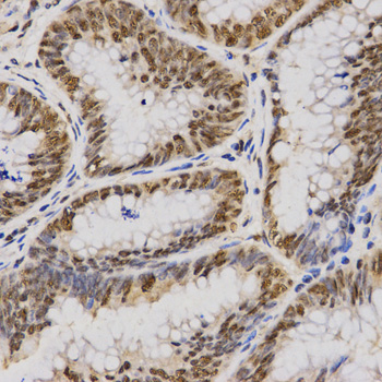 SKIV2L2 Antibody - Immunohistochemistry of paraffin-embedded human rectal cancer tissue using MTR4 antibody at dilution of 1:200 (x400 lens)