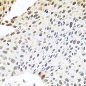 SKIV2L2 Antibody - Immunohistochemistry of paraffin-embedded human lung cancer tissue.