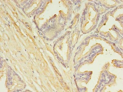 SLC25A25 Antibody - Immunohistochemistry of paraffin-embedded human prostate cancer using antibody at dilution of 1:100.