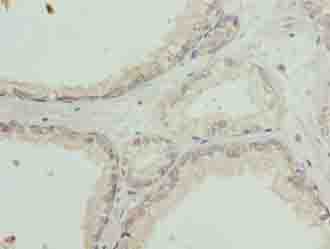 SLC31A2 Antibody - Immunohistochemistry of paraffin-embedded human prostate cancer using antibody at dilution of 1:100.