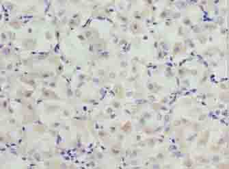 SLC31A2 Antibody - Immunohistochemistry of paraffin-embedded human gastric cancer using antibody at dilution of 1:100.