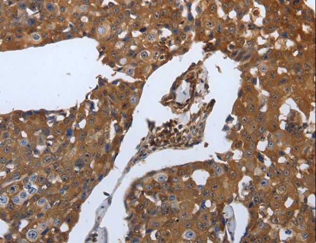 SLC34A2 / NaPi-2b Antibody - Immunohistochemistry of paraffin-embedded Human ovarian cancer using SLC34A2 Polyclonal Antibody at dilution of 1:70.