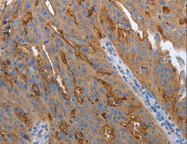 SLC34A2 / NaPi-2b Antibody - Immunohistochemistry of paraffin-embedded Human ovarian cancer using SLC34A2 Polyclonal Antibody at dilution of 1:70.