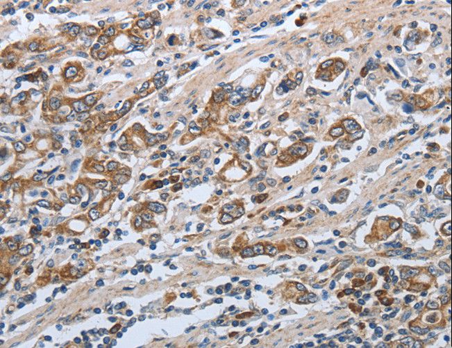 SLC34A2 / NaPi-2b Antibody - Immunohistochemistry of paraffin-embedded Human ovarian cancer using SLC34A2 Polyclonal Antibody at dilution of 1:50.