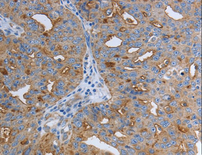 SLC34A2 / NaPi-2b Antibody - Immunohistochemistry of paraffin-embedded Human ovarian cancer using SLC34A2 Polyclonal Antibody at dilution of 1:50.