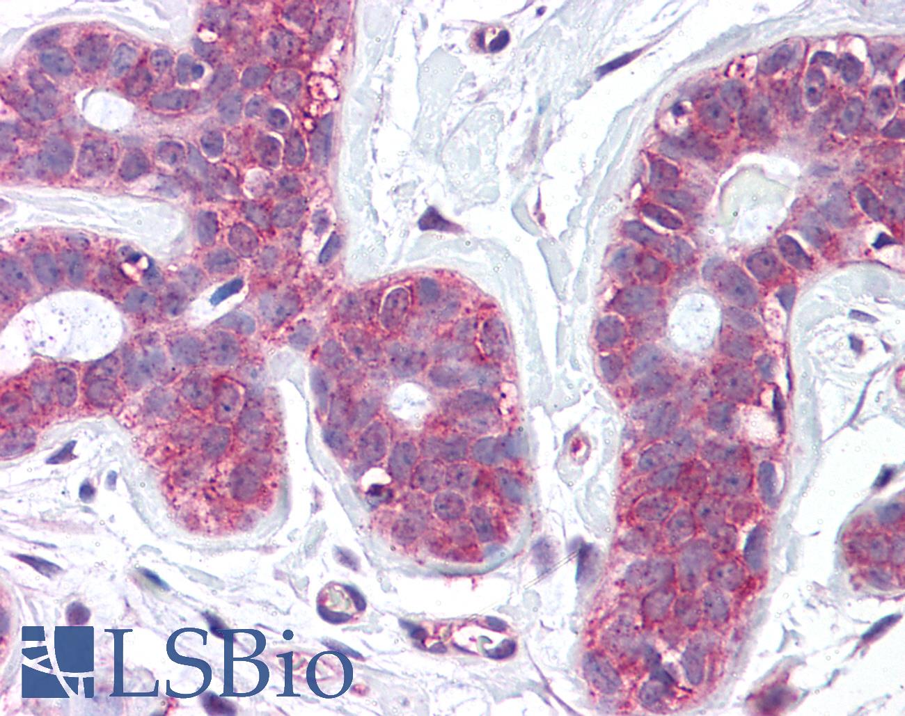 SLC39A6 / LIV-1 Antibody - Anti-SLC39A6 antibody IHC of human breast. Immunohistochemistry of formalin-fixed, paraffin-embedded tissue after heat-induced antigen retrieval.